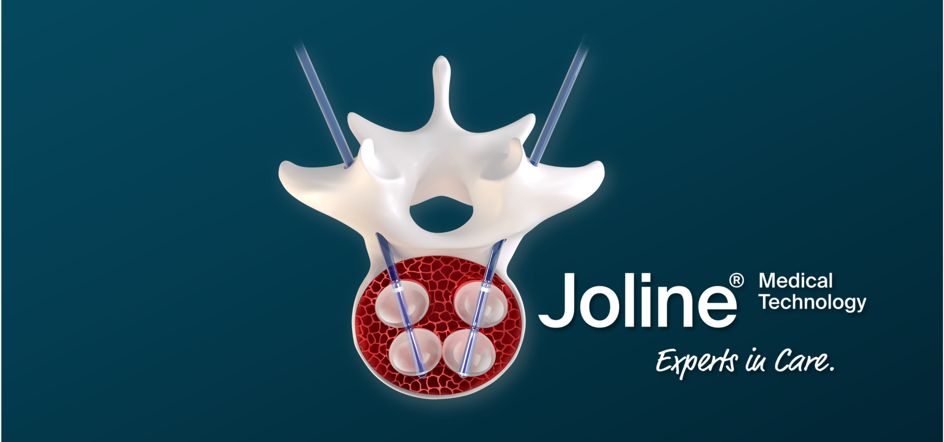 CIFOPLASTIA - VERTEBROPLASTIA