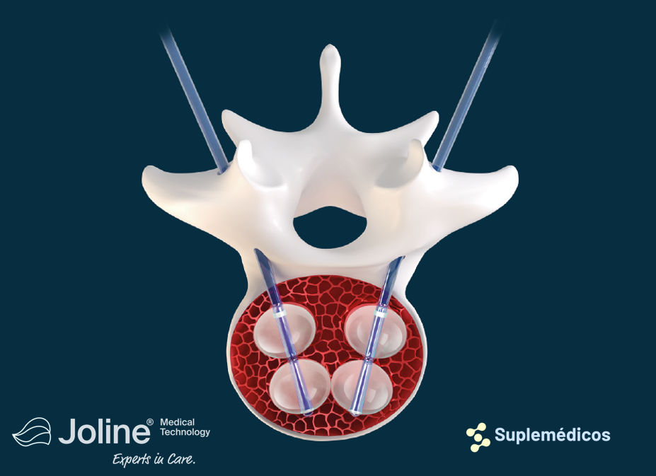 CIFOPLASTIA - VERTEBROPLASTIA
